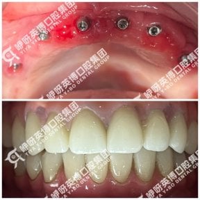 Результаты до и после имплантации зубов в Wuhan Yiya Simei Dental Hospital, восстановленная улыбка