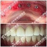 Результаты до и после имплантации зубов в Wuhan Yiya Simei Dental Hospital, восстановленная улыбка