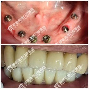 Результаты до и после имплантации зубов в Wuhan Yiya Simei Dental Hospital, восстановленная улыбка
