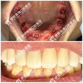 Результаты до и после имплантации зубов в Wuhan Yiya Simei Dental Hospital, восстановленная улыбка