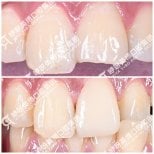 Результат до и после установки виниров Emax в Wuhan Yiya Simei Dental Hospital, улыбка
