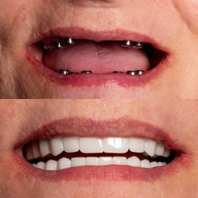before-after photo implantaciya-zubov-po-tehnologii-all-on-6--vse-na-chetureh