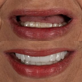 before-after photo implantaciya-zubov-po-tehnologii-all-on-4--vse-na-chetureh