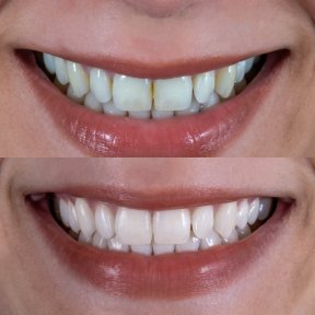 before-after photo otbelivanie-zubov