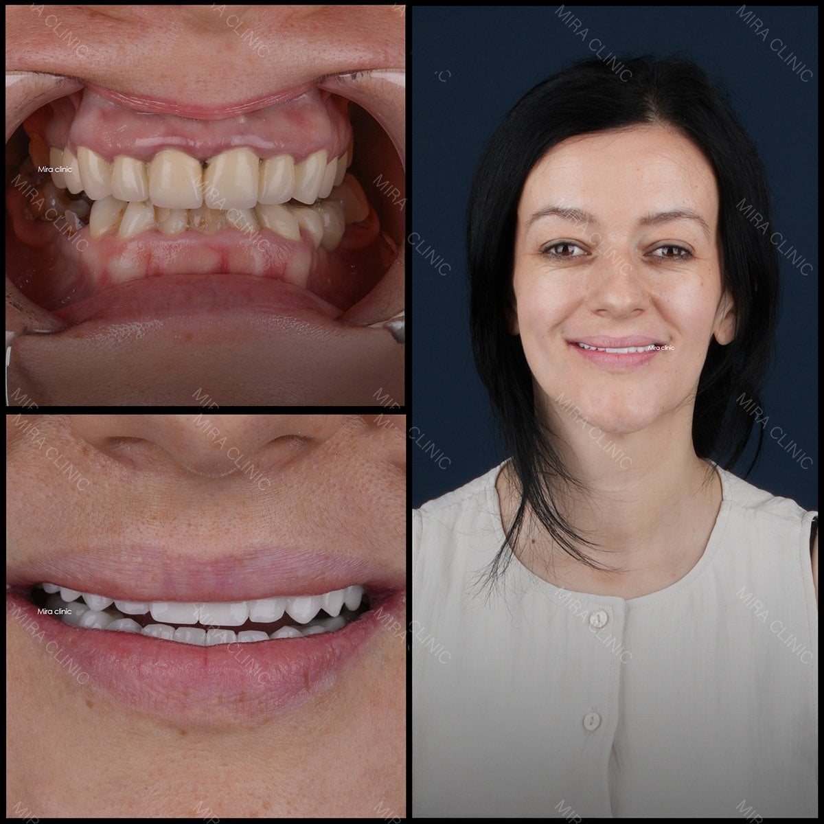 Resultados de injerto óseo y restauración dental en Mira Clinic, sonrisa mejorada