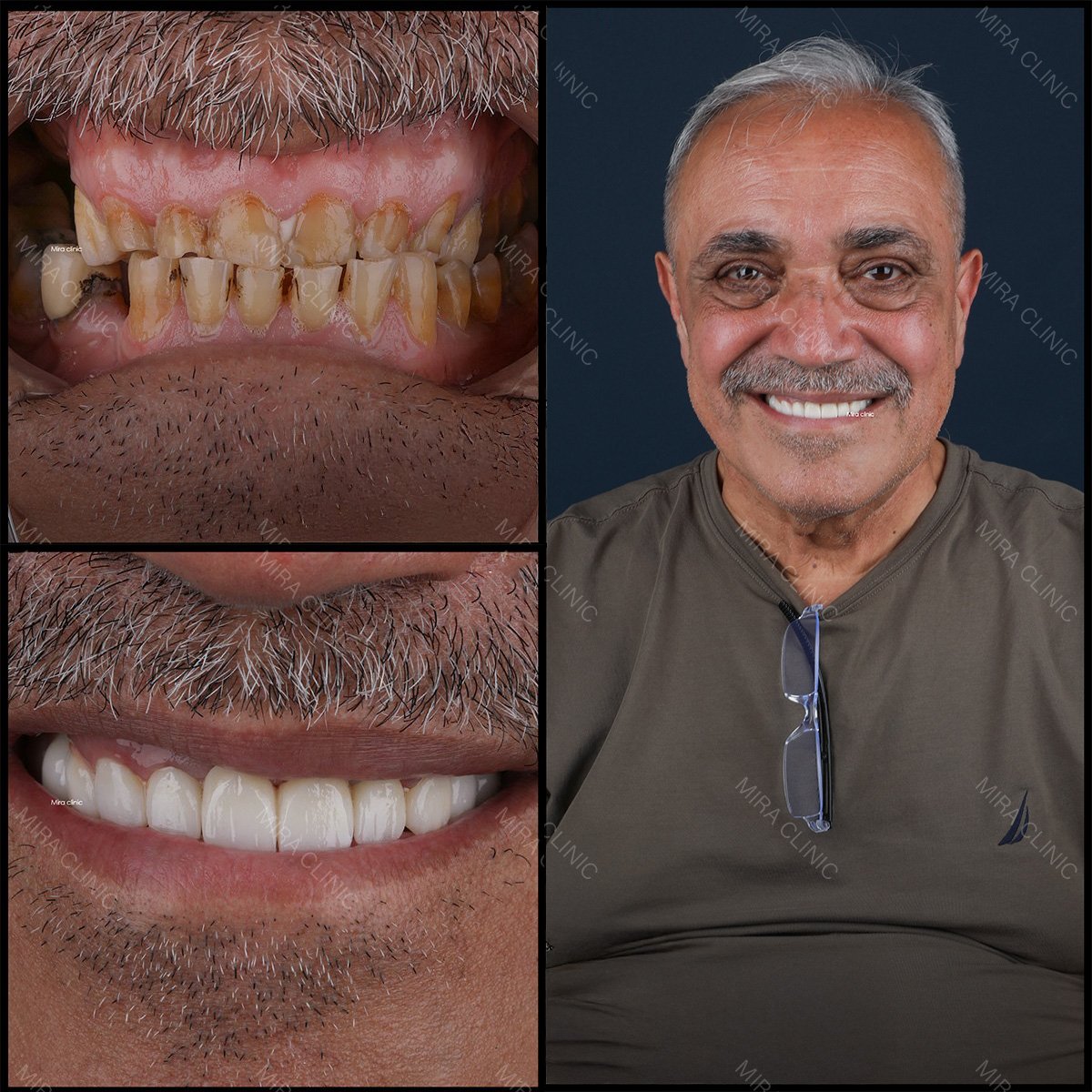 Resultados antes y después de injerto óseo y restauración dental en Mira Clinic, sonrisa mejorada