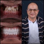 Результаты до и после имплантации зубов в Mira Clinic, восстановленная улыбка и зубы