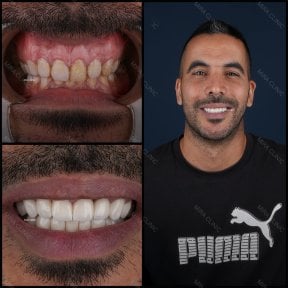 Antes y después de carillas dentales en Mira Clinic, transformación de sonrisa natural