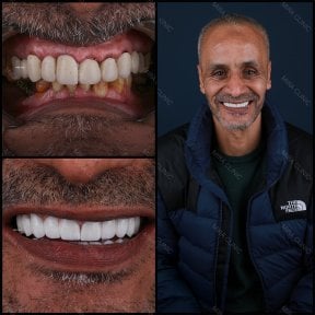 Resultado de cambio de sonrisa con carillas dentales en Mira Clinic (Mira Clinic SAĞLIK TURİZM ŞİRKETİ)