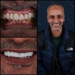 Resultado de cambio de sonrisa con carillas dentales en Mira Clinic (Mira Clinic SAĞLIK TURİZM ŞİRKETİ)