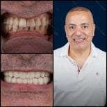 Resultados antes y después de carillas dentales en Mira Clinic, sonrisa mejorada y dientes blancos