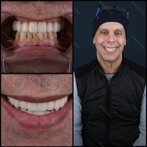Resultados antes y después de carillas dentales en Mira Clinic, sonrisa mejorada y dientes blancos