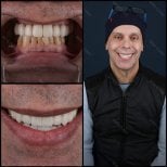 Resultados antes y después de carillas dentales en Mira Clinic, sonrisa mejorada y dientes blancos