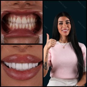 Zirconia crown installation results at Mira Clinic, smile makeover with natural white teeth