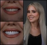 Before and after zirconia crown results at Mira Clinic, smile makeover with natural teeth