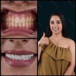 Before and after zirconia crown results at Mira Clinic, smile makeover with whiter teeth