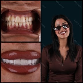 Before and after zirconia crown results at Mira Clinic, smile makeover with natural teeth