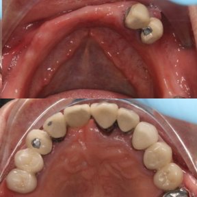 before-after photo dental-implant