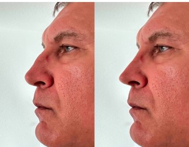 before-after photo rhinoplasty-nose-job