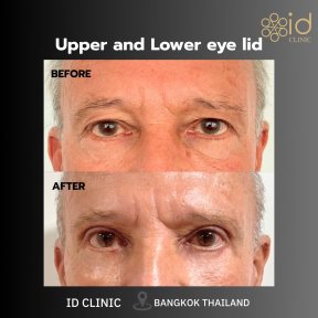 before-after photo lower-eyelid-surgery