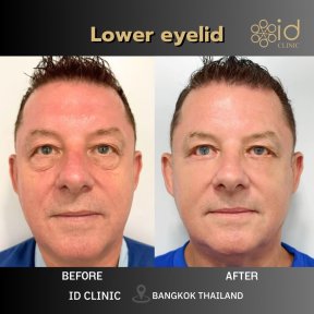 before-after photo lower-eyelid-surgery