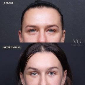 before-after photo tightening-of-facial-skin-facelift
