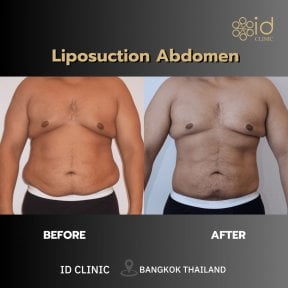 Результати ліпосакції живота до і після в ID Clinic Bangkok, помітне моделювання тіла