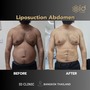 Результати ліпосакції живота до і після в ID Clinic Bangkok, помітне зменшення жиру