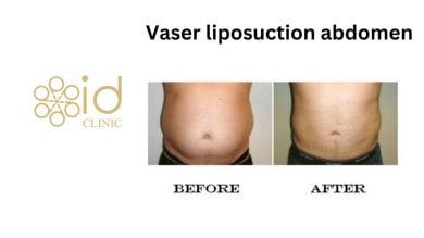 Результати Vaser ліпосакції живота до і після в ID Clinic Bangkok, помітне зменшення жиру