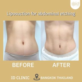 До і після ліпосакції для абдомінального етчингу в ID Clinic Bangkok, помітний результат