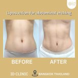 До і після ліпосакції для абдомінального етчингу в ID Clinic Bangkok, помітний результат
