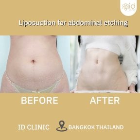 Результати ліпосакції живота до і після в ID Clinic Bangkok