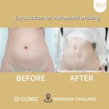 Результати ліпосакції живота до і після в ID Clinic Bangkok