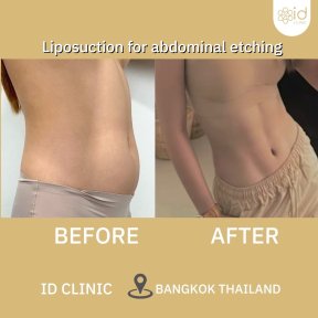 До і після ліпосакції живота з контурингом в ID Clinic Bangkok, чіткий прес