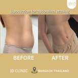 До і після ліпосакції живота з контурингом в ID Clinic Bangkok, чіткий прес
