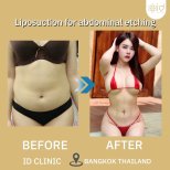 До і після ліпосакції з абдомінальним контурингом в ID Clinic Bangkok, помітний результат