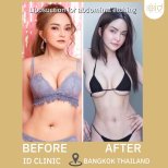 До та після ліпосакції для абдомінального етчингу в ID Clinic Bangkok, чітка талія