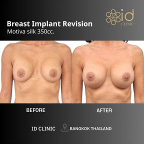 Результати до та після заміни грудних імплантів Motiva 350cc в ID Clinic Bangkok