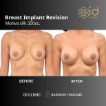 Результати до та після заміни грудних імплантів Motiva 350cc в ID Clinic Bangkok