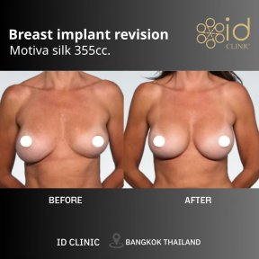 Результати до і після заміни грудних імплантів Motiva 355cc в ID Clinic Bangkok
