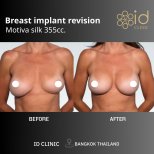 Результати до і після заміни грудних імплантів Motiva 355cc в ID Clinic Bangkok