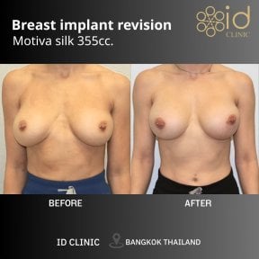 Результати до і після заміни грудних імплантів Motiva 355cc в ID Clinic Bangkok