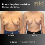 Результати до і після заміни грудних імплантів Motiva 355cc в ID Clinic Bangkok