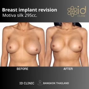Результати до і після заміни грудних імплантів Motiva 295cc в ID Clinic Bangkok