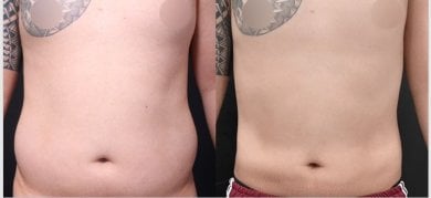 Vorher-nachher-Liposuktion bei VG Plastic Surgery – sichtbare Bauchkontur-Verbesserung