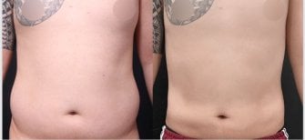 Vorher-nachher-Liposuktion bei VG Plastic Surgery – sichtbare Bauchkontur-Verbesserung