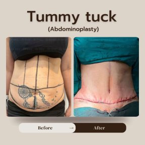 Résultats avant et après abdominoplastie à Intrarat Hospital, amélioration du contour abdominal