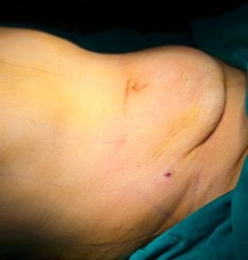 Contour abdominal avant abdominoplastie et liposuccion chez Turan Turan Health Group