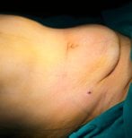 Contour abdominal avant abdominoplastie et liposuccion chez Turan Turan Health Group