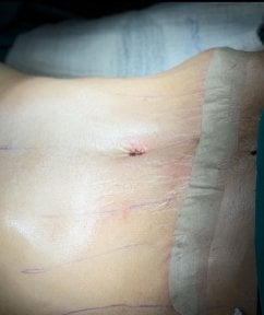 Résultat d'abdominoplastie et liposuccion chez Turan Turan Health Group, amélioration du contour abdominal